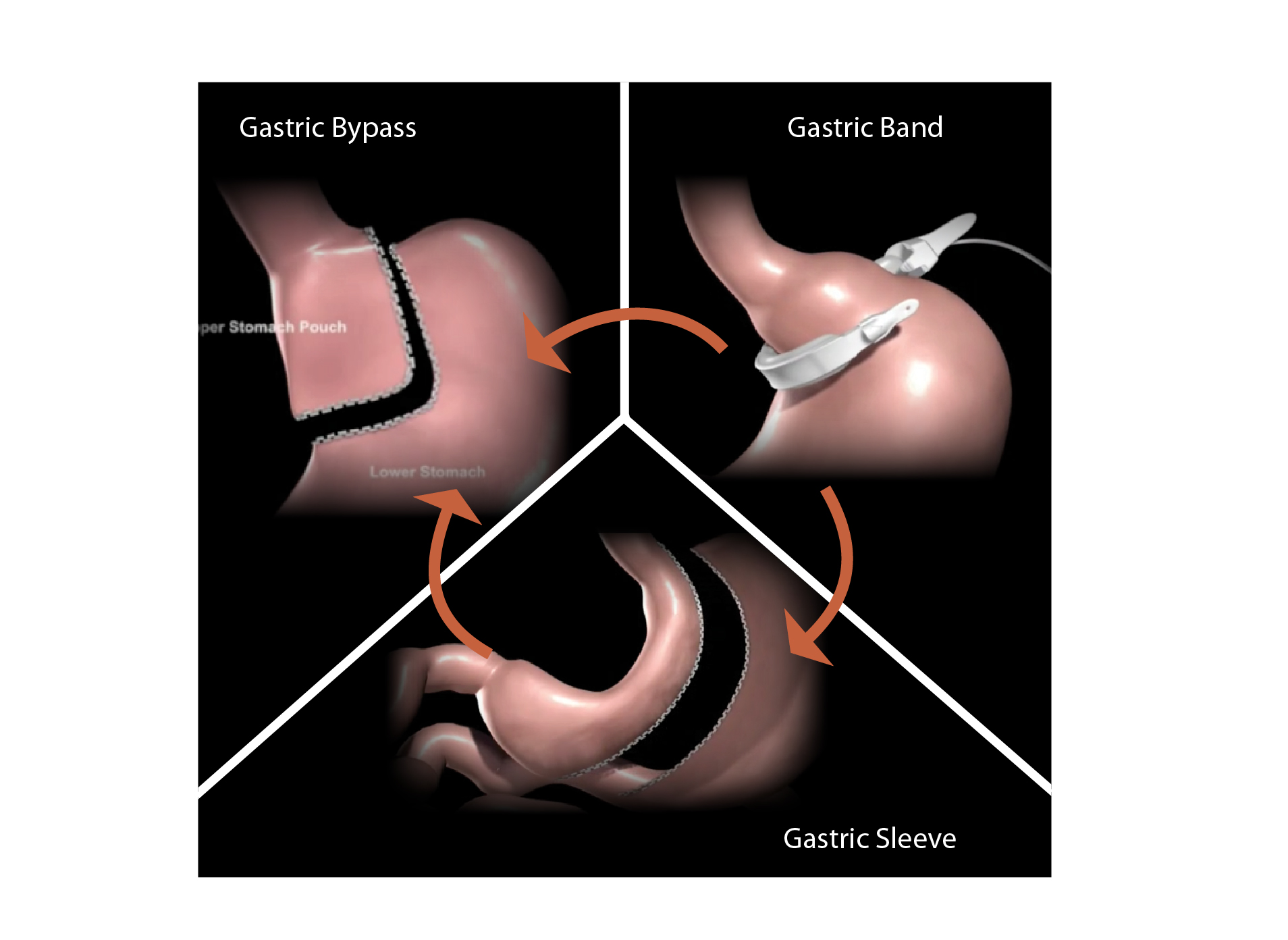 Lap Band Revision Surgery in Central NJ Prime Surgicare