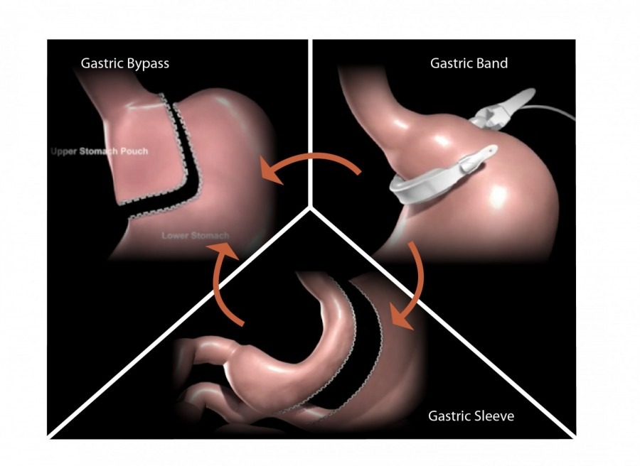 revision-weight-loss-surgery-centre-for-weight-loss