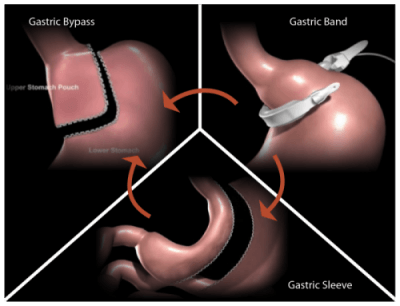 Revision Surgery by weight loss surgeon, Dr. Seun Sowemimo of Monmouth County, New Jersey