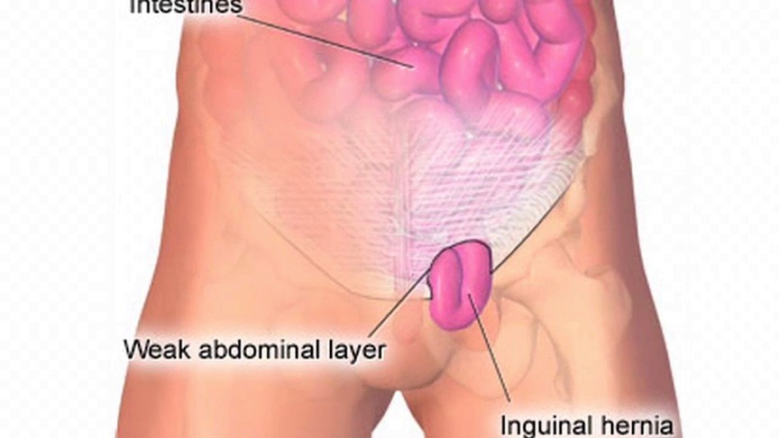 Hernias After Weight Loss Surgery: Are You at Risk? — by general and weight loss surgeon, Dr. Seun Sowemimo in Central, NJ. 