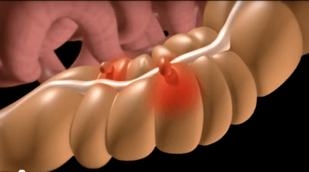 Undergo Colon Surgery for Diverticular Disease and Cancer by Dr. Seun Sowemimo of Prime Surgicare, Monmouth County, New Jersey