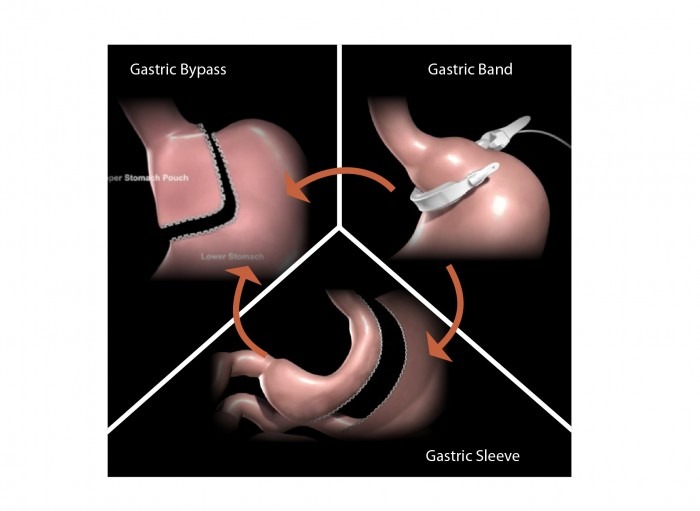 Gastric Sleeve Pre-Op Reveals Undiagnosed Heart Condition — Prime