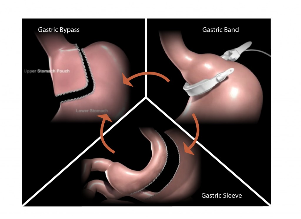 Revision Surgery by Dr. Seun Sowemimo, bariatric surgeon at Prime Surgicare, Monmouth County, New Jersey