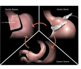 Bariatric Revision: Is It Time to Update Your Procedure?
