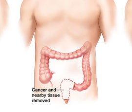 Colon Cancer can be Defeated  with Minimally Invasive Laparoscopic Surgery