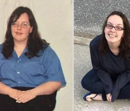 Weight Loss Surgery Gave Me the Chance to Truly Smile