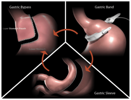 Lap band failure? Dr. Seun Sowemimo specializes in bariatric revision surgery.