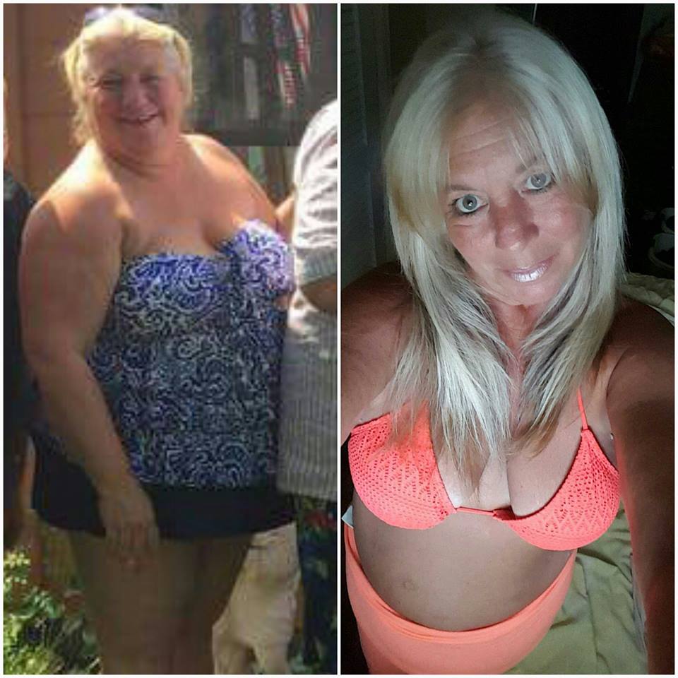 Lori Dyas before and after weight loss surgery at Prime Surgicare, Central NJ.