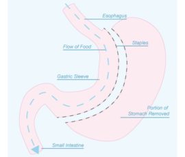Why the Gastric Sleeve is the Most Popular Bariatric Surgery