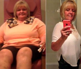 A Testimonial from Gastric Sleeve Patient, Sue Stephenson