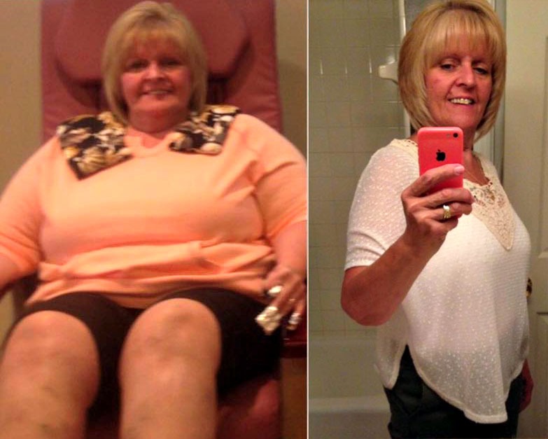 Sue S. before and after bariatric surgery at Prime Surgicare in Central NJ