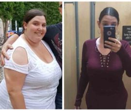 Bariatric Surgery Helps Overcome PCOS Weight Gain