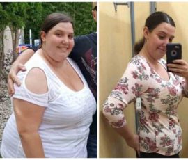 Gastric sleeve surgery gone wrong resulted in deadly anorexia