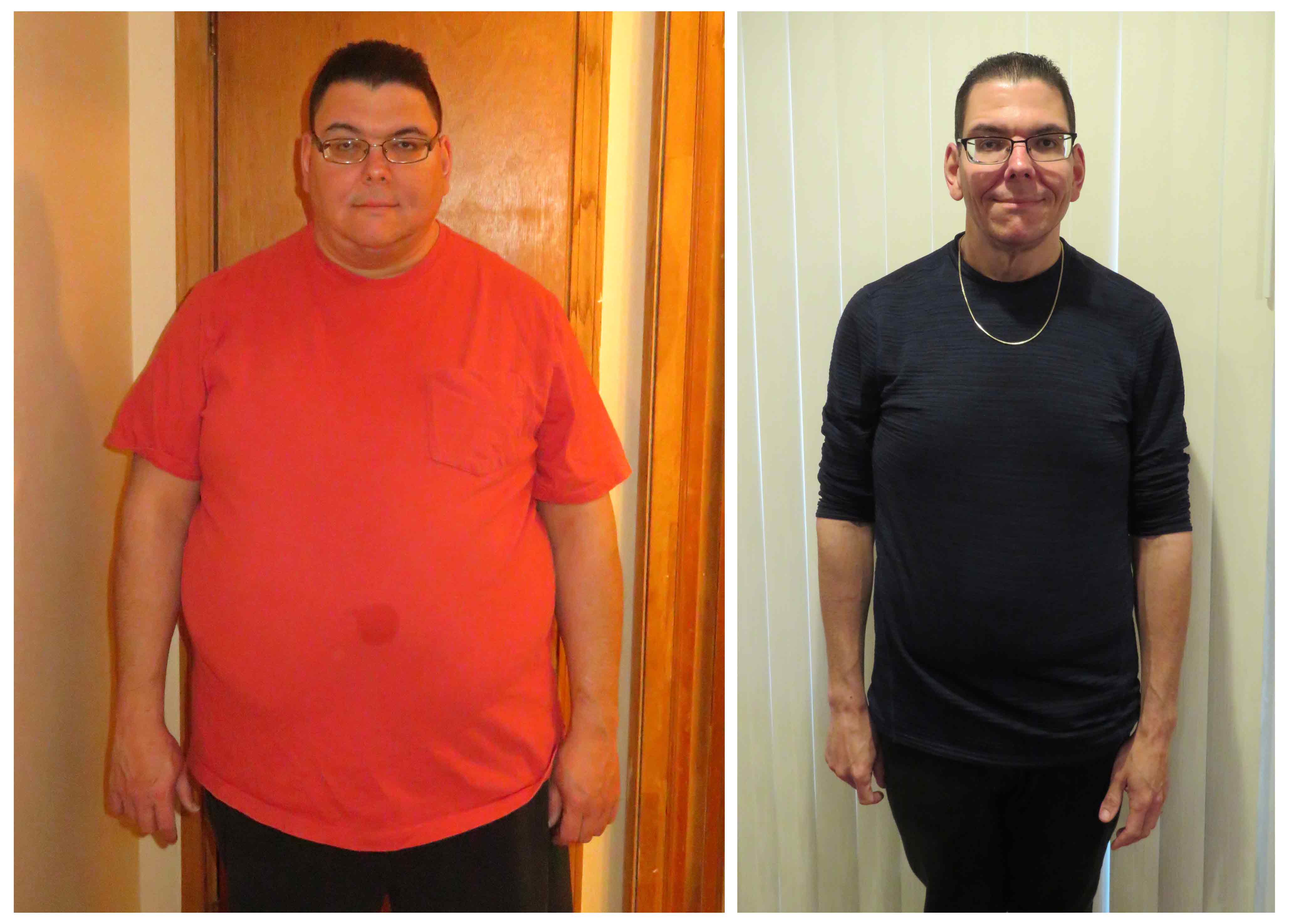 Gastric Bypass Before And After Pictures Men 6364