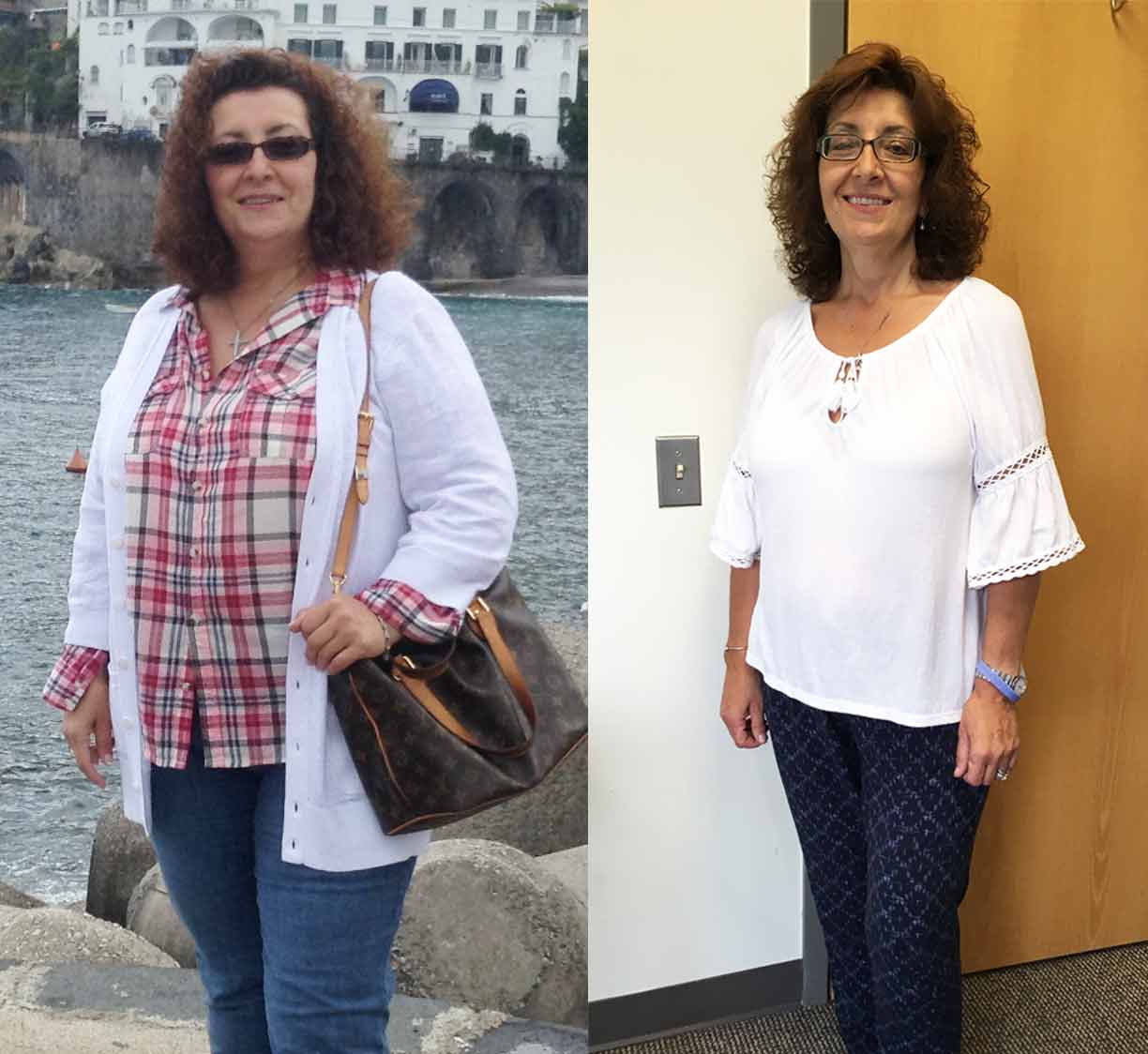 Angelina before and after bariatric surgery at Prime Surgicare in Central New Jersey.