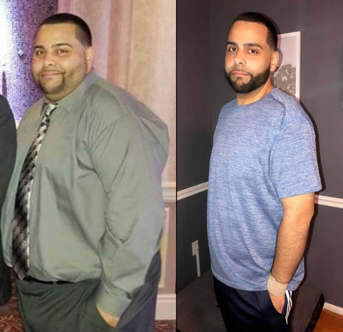 gastric bypass before and after pictures men