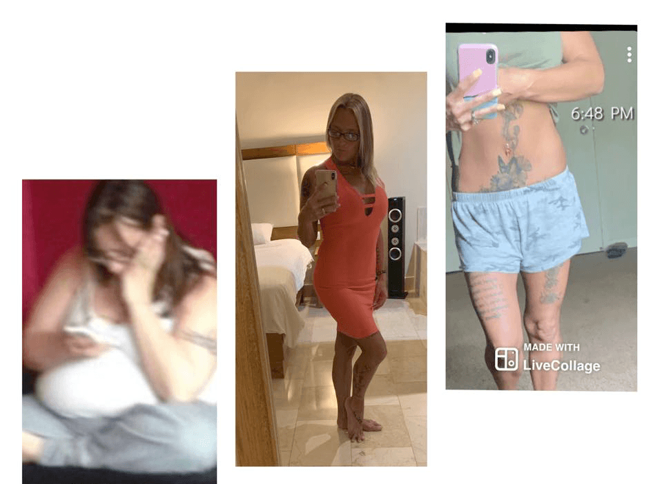 VSG weight loss surgery patient