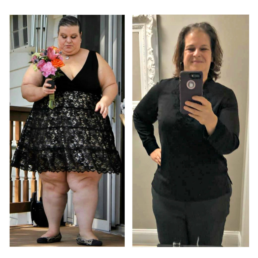 Kimberly celebrates 215-pound weight loss after gastric sleeve