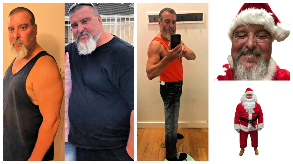 Joe had gastric sleeve bariatric surgery perform by Seun Sowemimo and lost 110 pounds