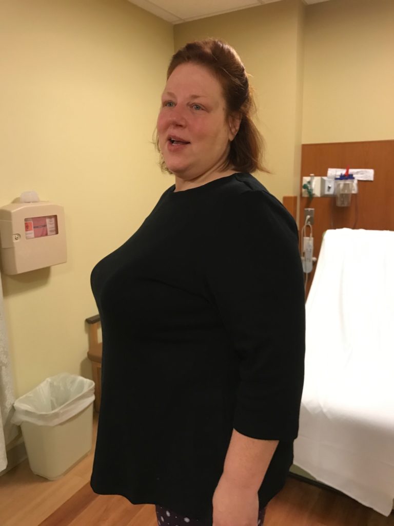 Barbara is shown before she had gastric sleeve bariatric weight loss surgery performed by Dr. Sowemimo in Freehold, NJ.