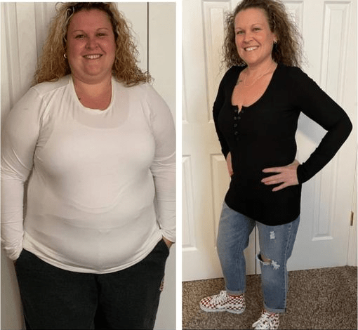 Andrea Steinberg had gastric sleeve weight loss surgery performed by Dr. Sowemimo and reached goal weight one year after her weight loss surgery operation.