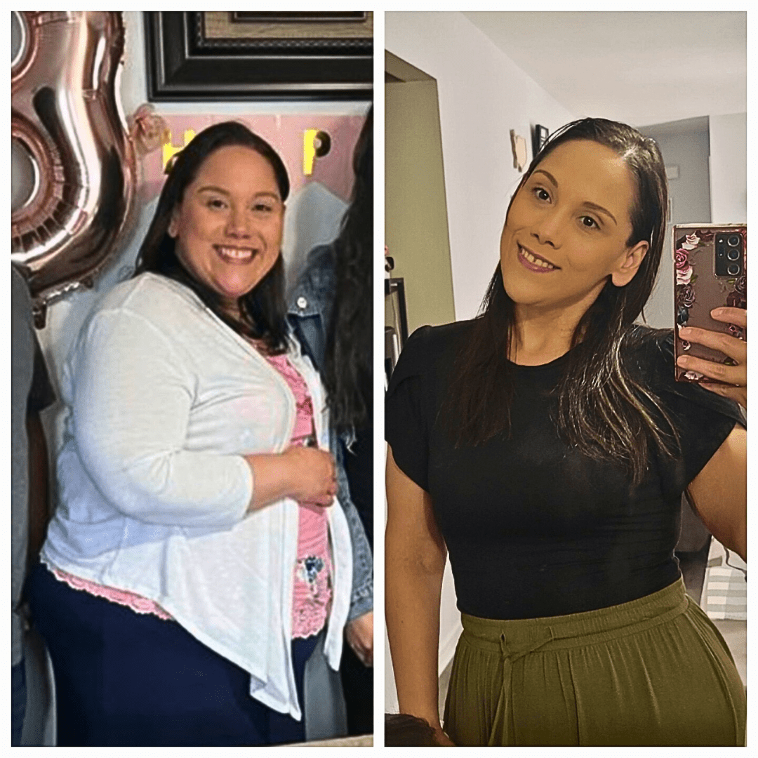 Bariatric Gastric Sleeve Surgery Results - 6 Months Post-Op